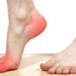 neuron disease treatment